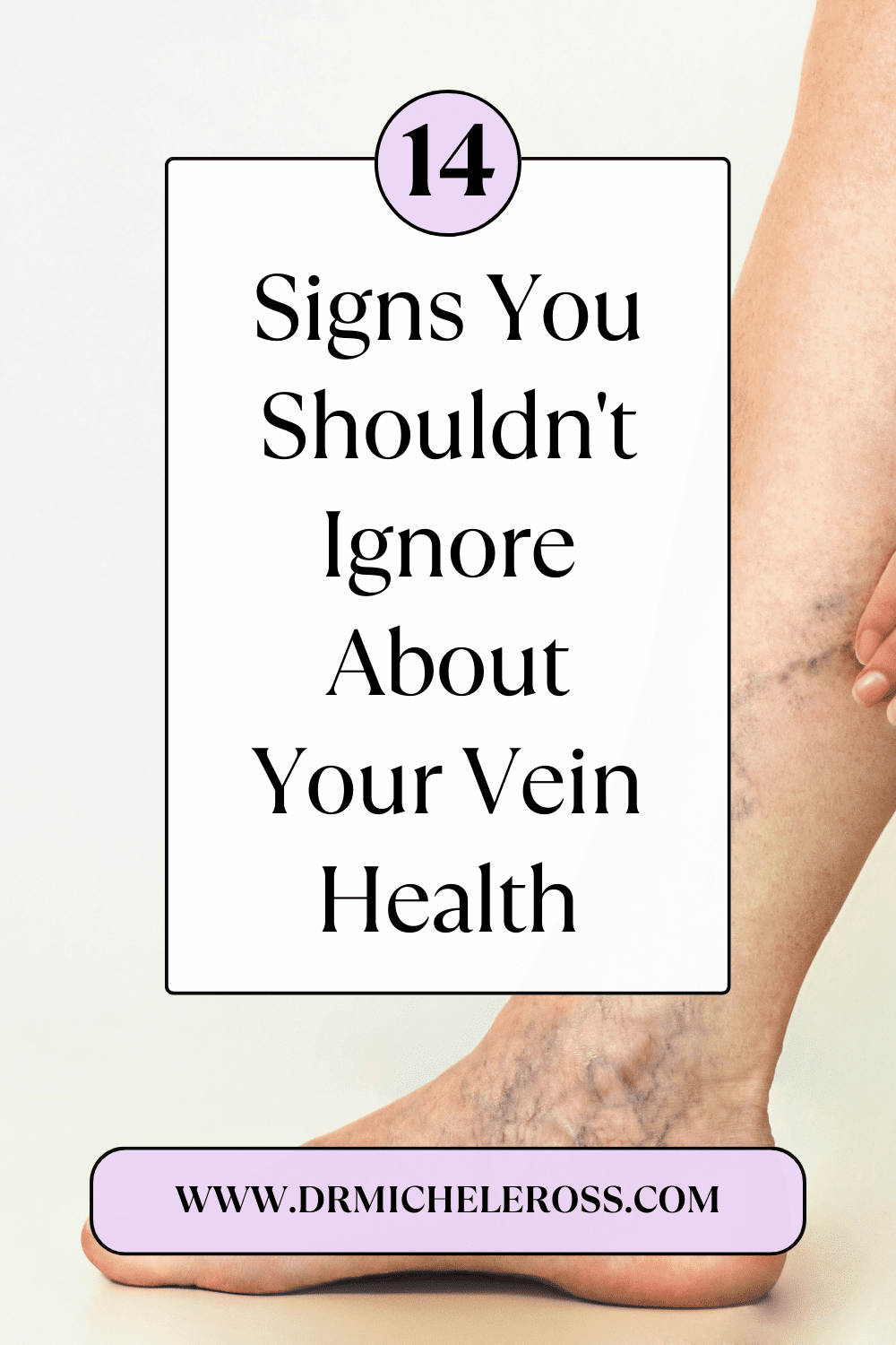 varicose veins on leg poor vein health