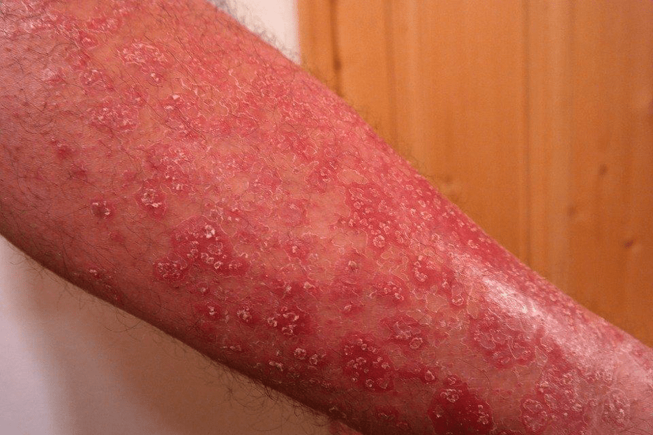 red, itchy skin causes by psoriasis inflammation can be helped by cbd oil