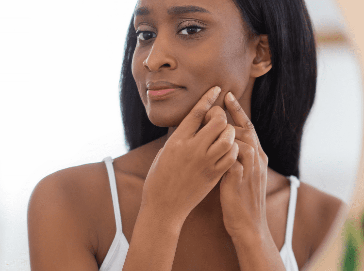 young black woman applying cbd skincare for acne