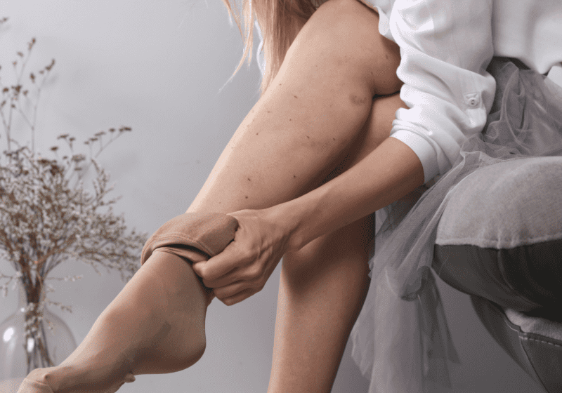 young woman with blond hair putting on compression stocking over leg with bruises