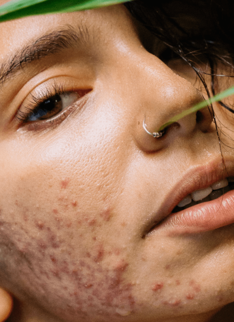 young woman with inflamed cystic acne needs cbd cream hiding her face