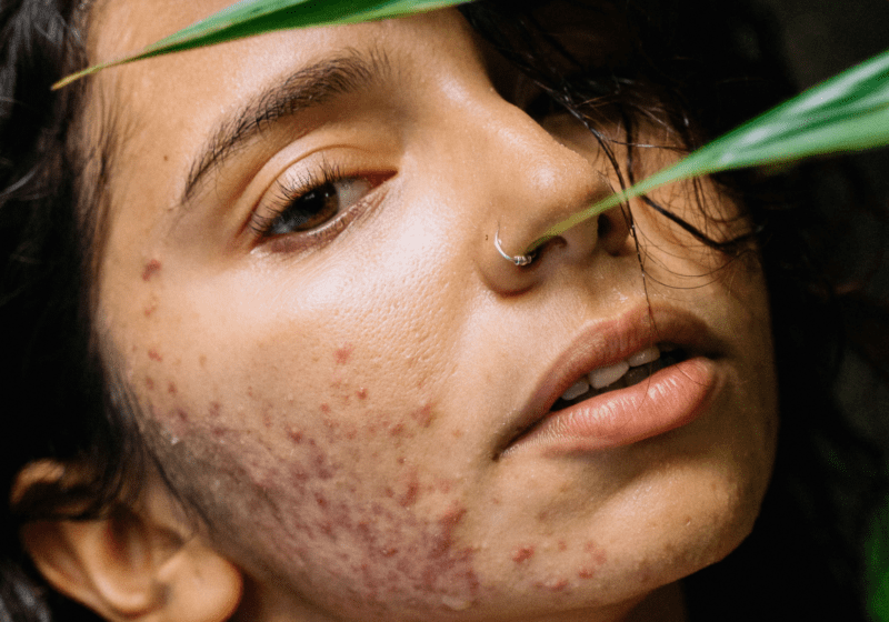young woman with inflamed cystic acne needs cbd cream hiding her face