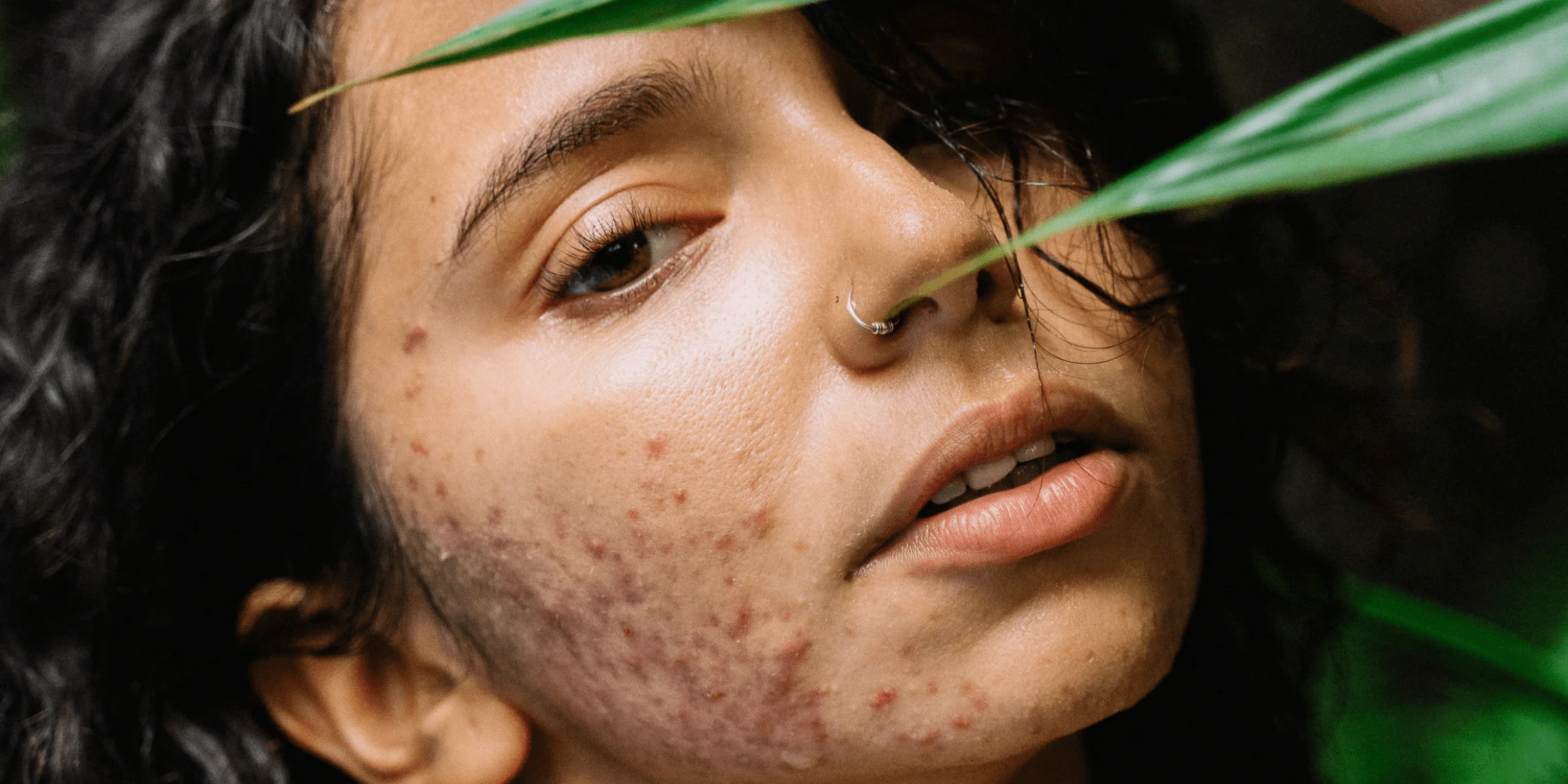 young woman with inflamed cystic acne needs cbd cream hiding her face