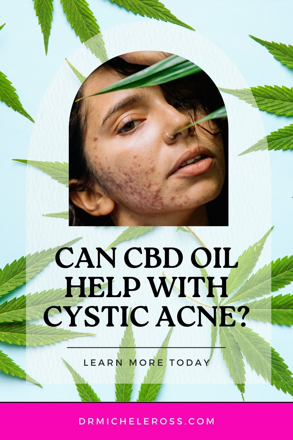 woman with hormonal cystic acne needs cbd cream to heal inflammation