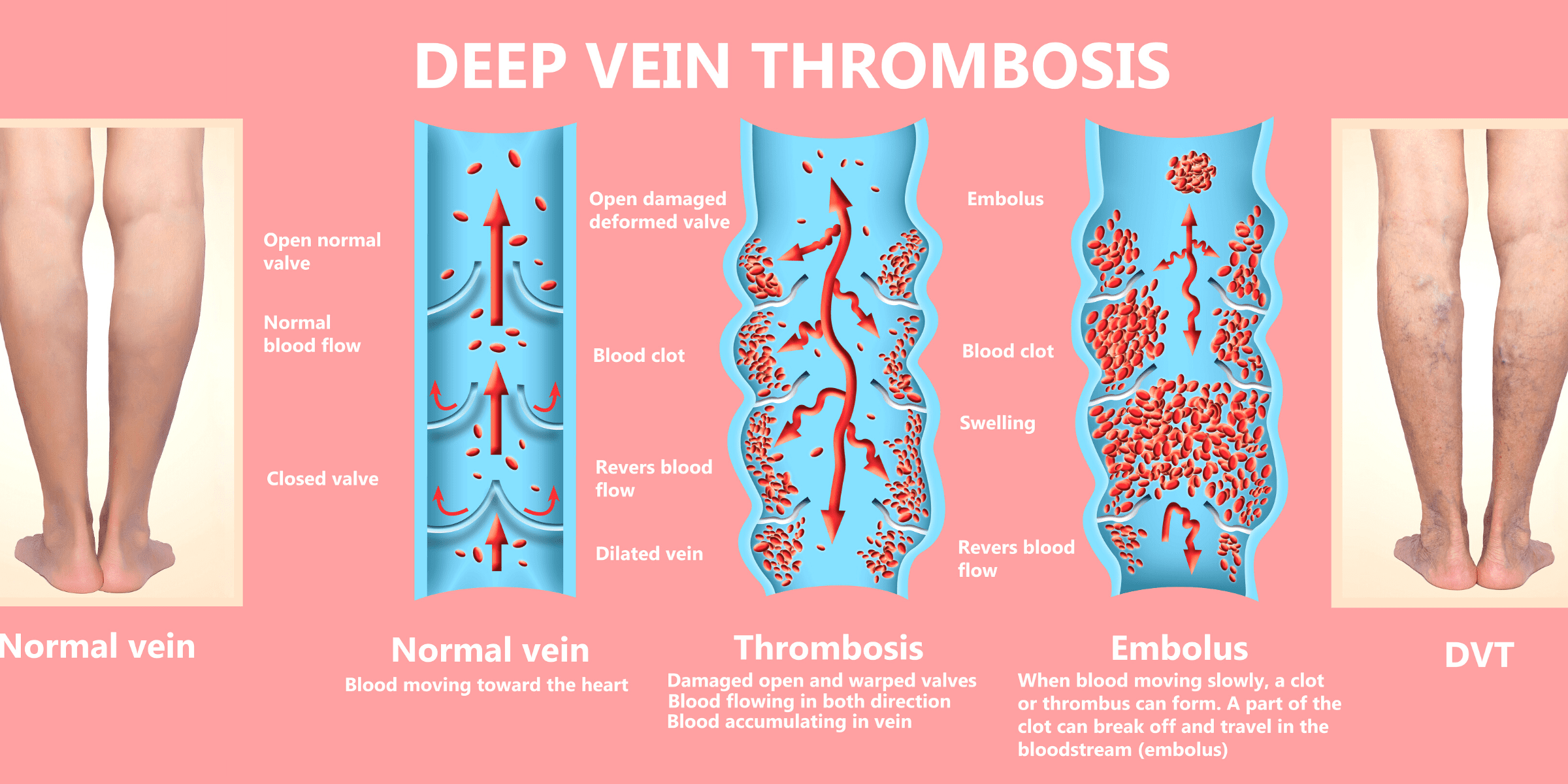 Deep Vein Thrombosis Normal Vein Embolus DVT Leg Swelling