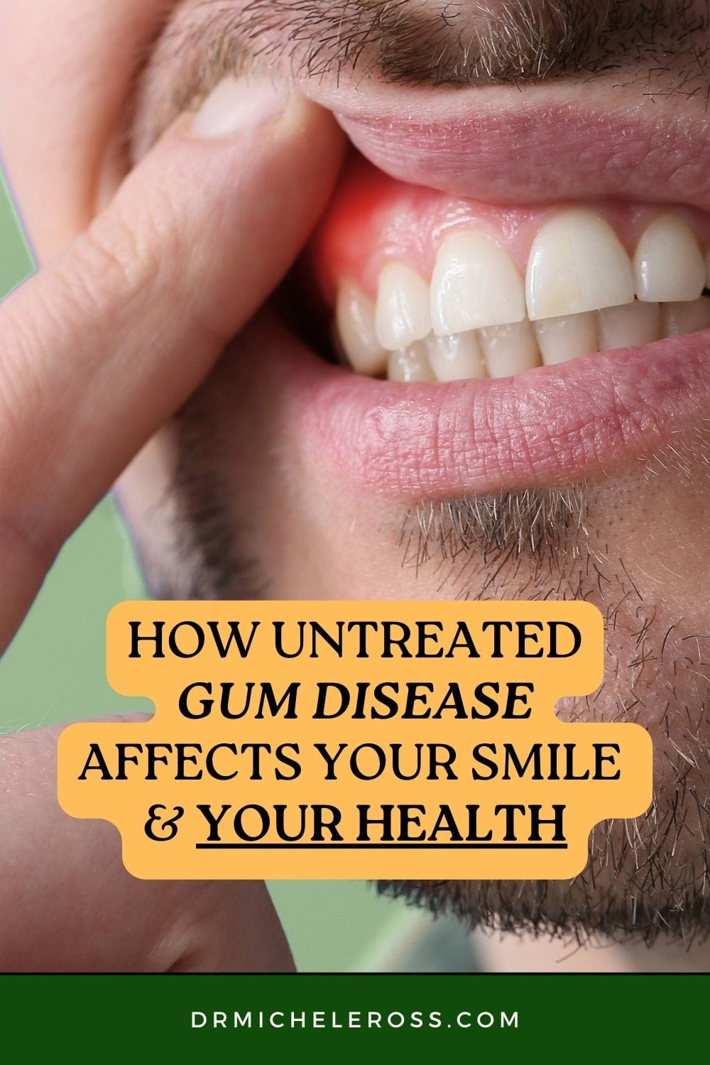 man pressing finger on inflamed gums with gum disease