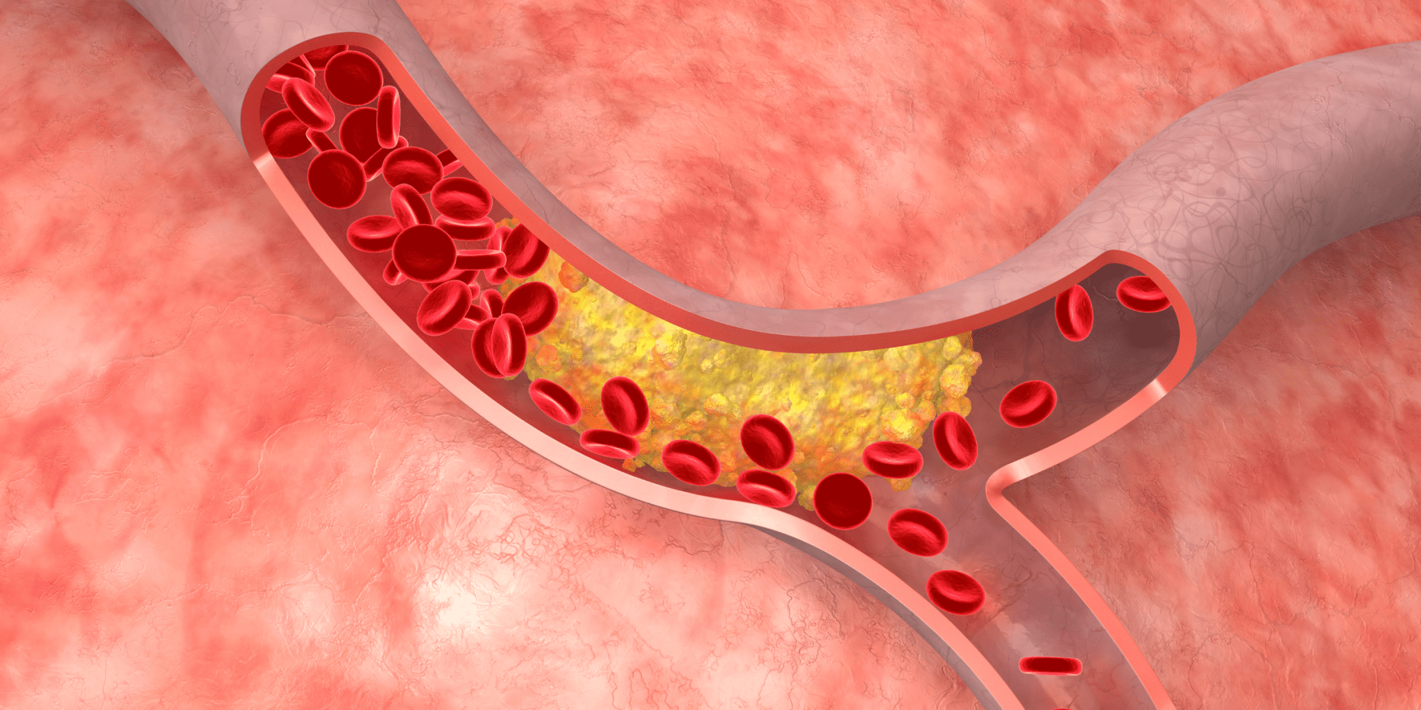 blood vessel clogged with cholesterol with PAD peripheral artery disease