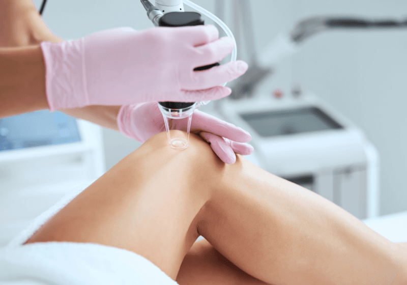 woman receiving Endovenous laser therapy treatment for spider veins