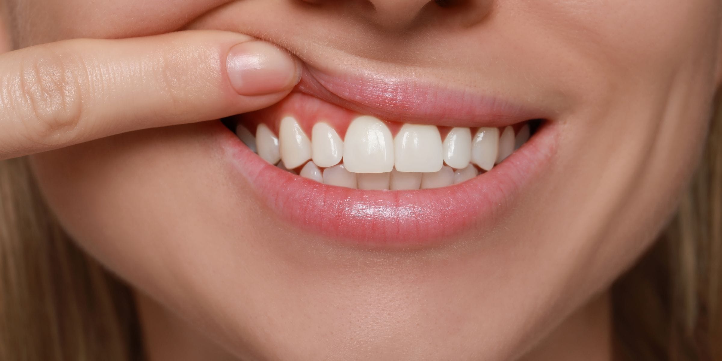 woman exposing gums that are red symptoms of gum disease