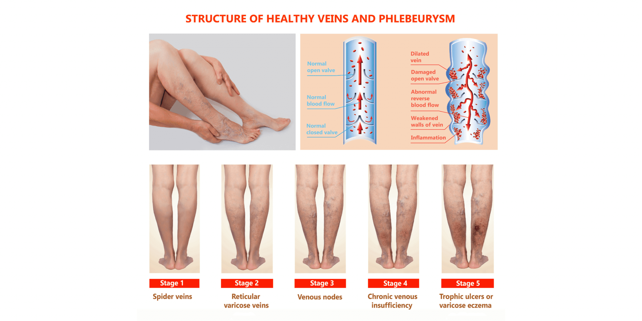 chronic venous insufficiency is stage 4 unhealthy veins